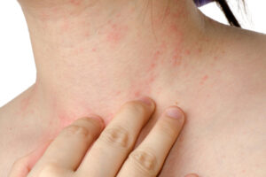 Read more about the article क्या होता है फंगल इंफेक्शन हमारी skin पर कैसे प्रभाव पड़ती है