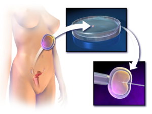 Read more about the article IVF Procedure: Guide to In Vitro Fertilization