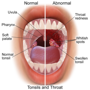 Read more about the article Strep Throat Self Care