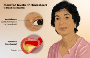 Read more about the article What are foods that cause high cholesterol?