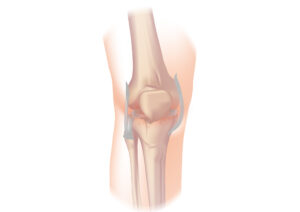 Read more about the article Osteoarthritis: Understanding and Managing Joint Health