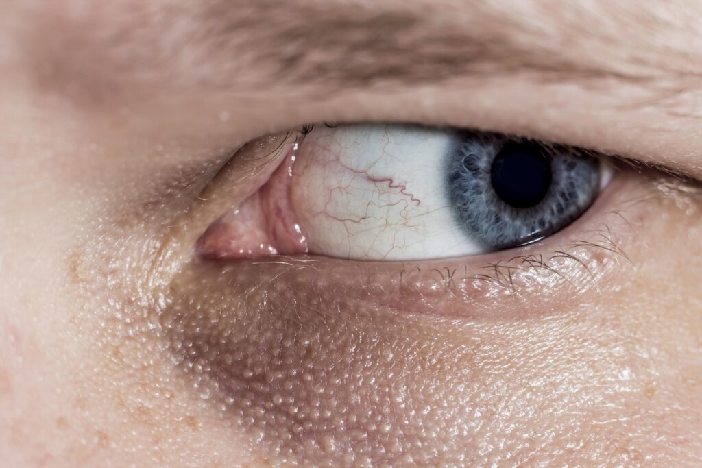 LASIK Relief: Managing Dry Eyes After Surgery