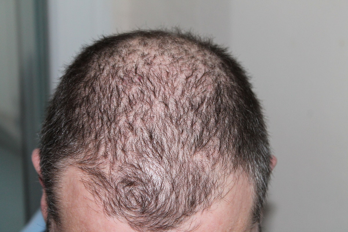 Read more about the article Hair Transplant Cost: Navigating the Maze of Pricing