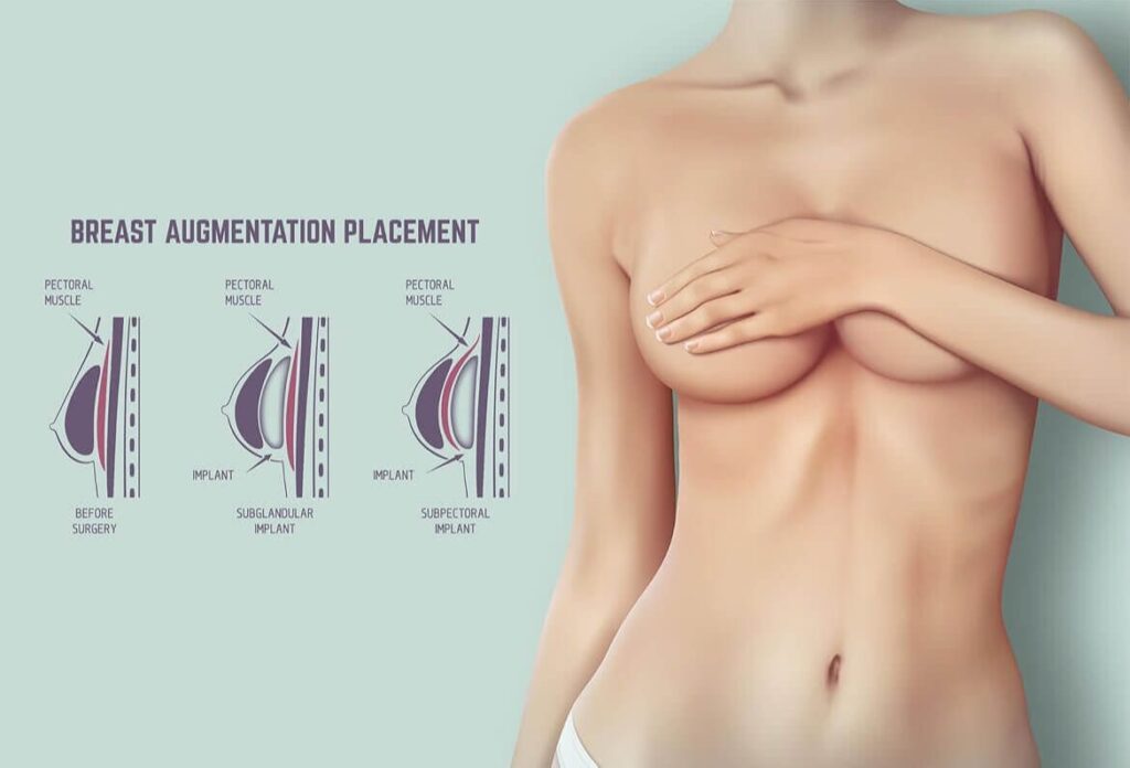 Celebrity Breast Augmentation: Redefining Beauty Standards