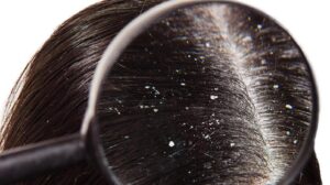 Read more about the article How to Prevent Dandruff in Winter