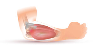 Read more about the article Tennis Elbow Treatment: A Comprehensive Guide