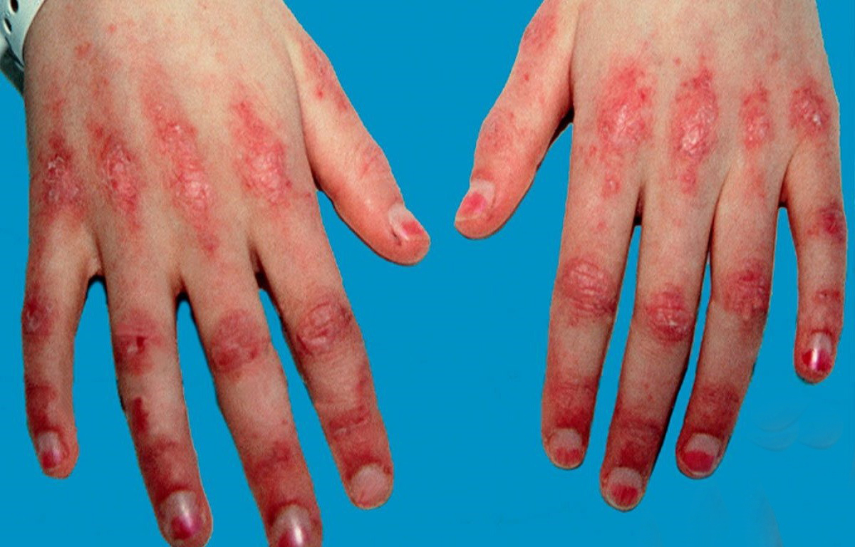 You are currently viewing How to Relieve Psoriasis Itch: A Comprehensive Guide